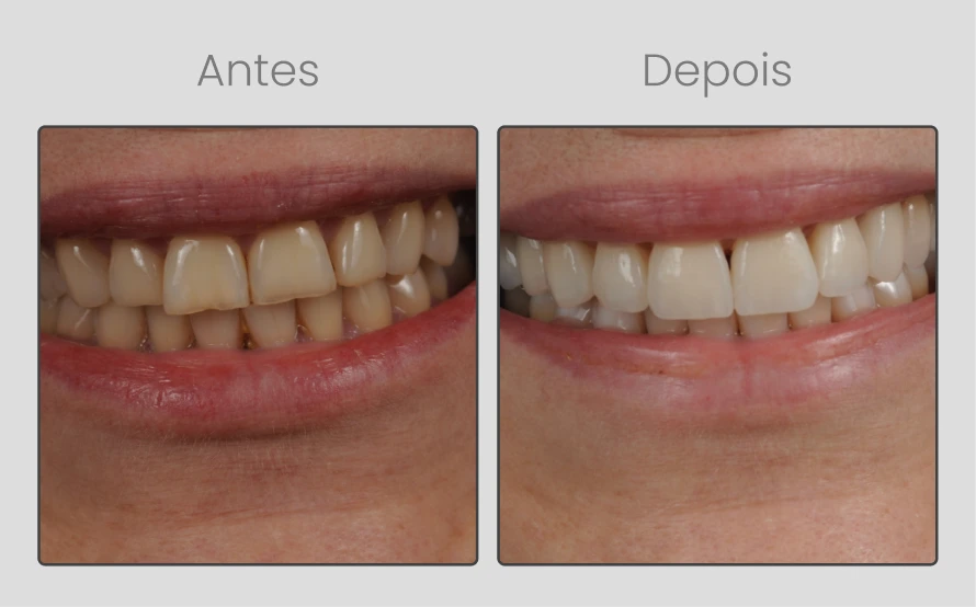 ANTESEDEPOIS-10.webp