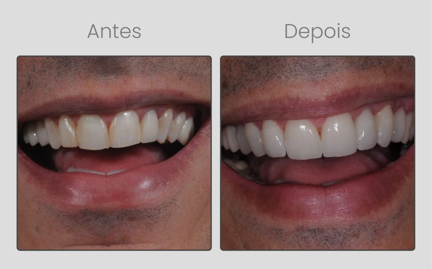 ANTESEDEPOIS-11.webp