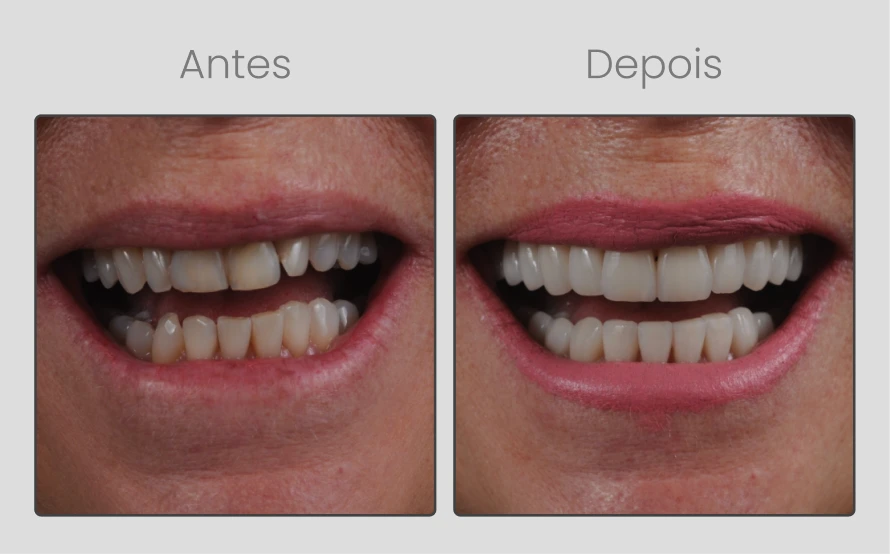 ANTESEDEPOIS-13.webp