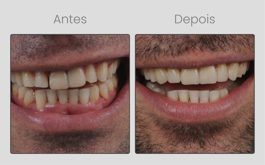 ANTESEDEPOIS-9.webp